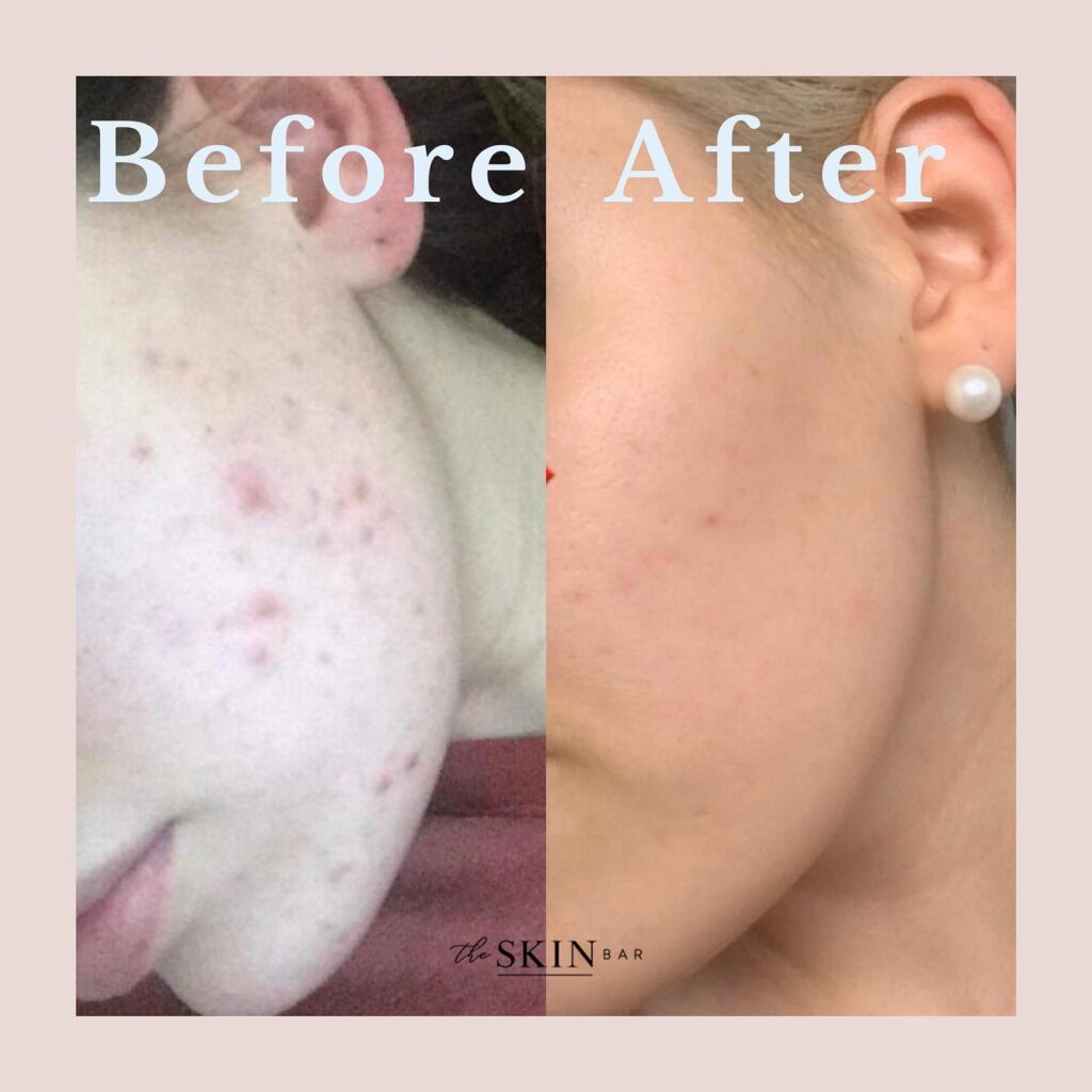 before and after of the skin treatment