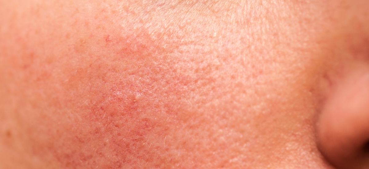 Impaired Barrier Irritated Skin Barriers can present as red, itchy, irritated, dry or inflammed