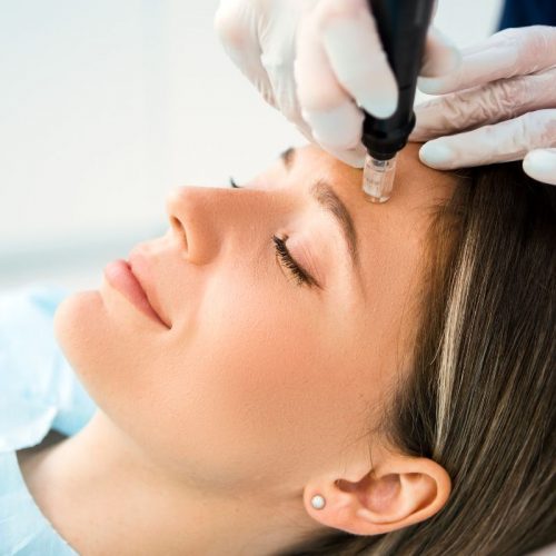 skin needling